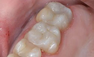 tooth-colored-fillings-after-2