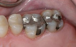 tooth-colored-fillings-before-2