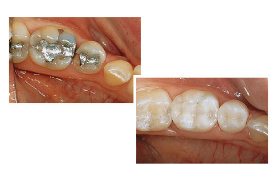 What Are Tooth Coloured Fillings?